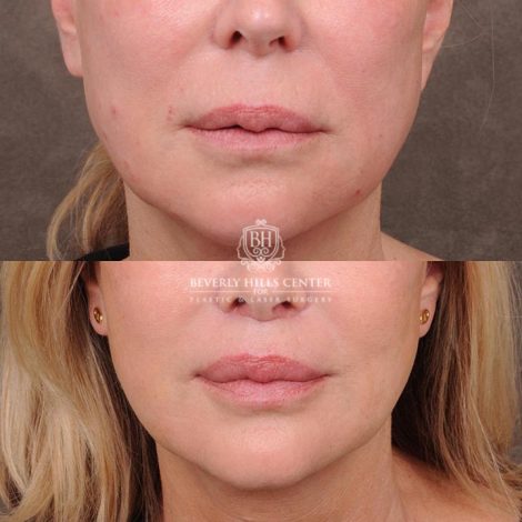 Beverly Hills Center Female Patient Before and After Lip Lift with Mucosal Reduction Procedure