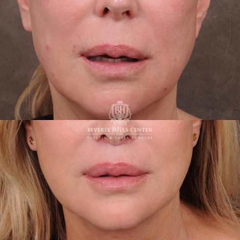 Beverly Hills Center Female Patient Before and After Lip Lift with Mucosal Reduction Procedure
