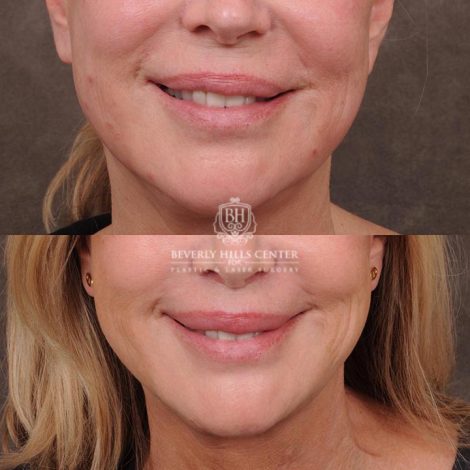 Beverly Hills Center Female Patient Before and After Lip Lift with Mucosal Reduction Procedure