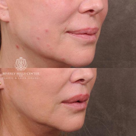 Beverly Hills Center Female Patient Before and After Lip Lift with Mucosal Reduction Procedure