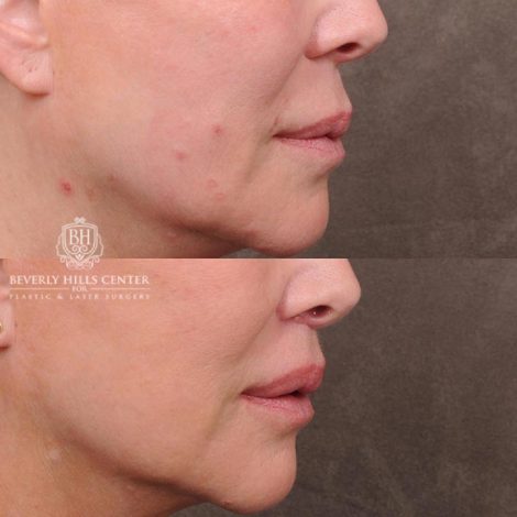 Beverly Hills Center Female Patient Before and After Lip Lift with Mucosal Reduction Procedure