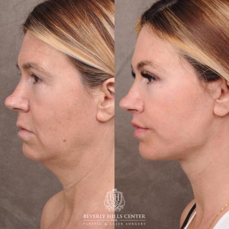 Beverly Hills Center Female Patient Before and After AuraLyft with TCA Peel and Lip Lif