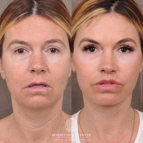 Beverly Hills Center Female Patient Before and After AuraLyft with TCA Peel and Lip Lif