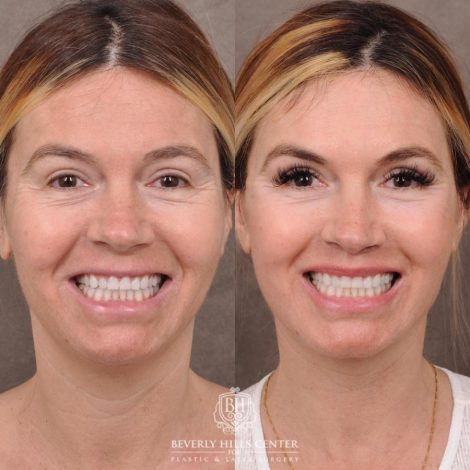 Beverly Hills Center Female Patient Before and After AuraLyft with TCA Peel and Lip Lif