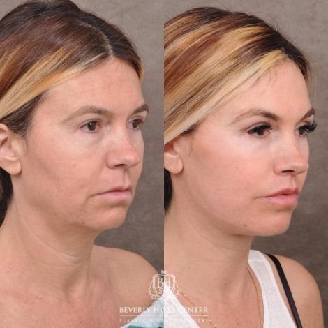 Beverly Hills Center Female Patient Before and After AuraLyft with TCA Peel and Lip Lif