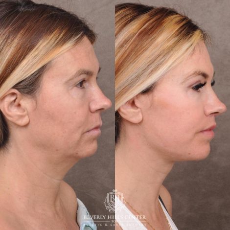 Beverly Hills Center Female Patient Before and After AuraLyft with TCA Peel and Lip Lif