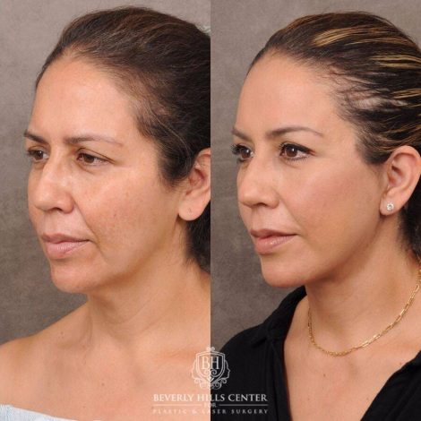 Beverly Hills Center Female Patient Before and After AuraLyft, Hybrid Endo Browlift