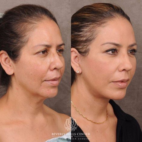 Beverly Hills Center Female Patient Before and After AuraLyft, Hybrid Endo Browlift