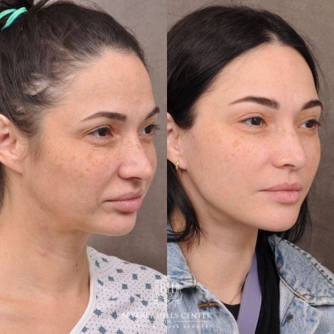 Beverly Hills Center Female Patient Before and After AuraLyft, Brow Lift, Upper Blepharoplasty
