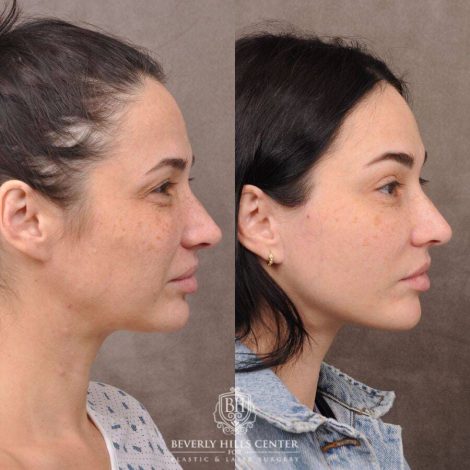Beverly Hills Center Female Patient Before and After AuraLyft, Brow Lift, Upper Blepharoplasty