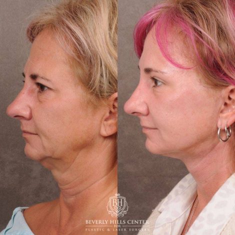 Beverly Hills Center Female Patient Before and After Comprehensive AuraLyft