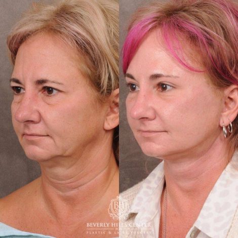 Beverly Hills Center Female Patient Before and After Comprehensive AuraLyft