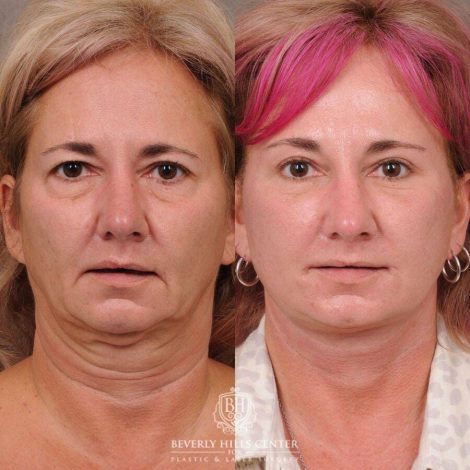 Beverly Hills Center Female Patient Before and After Comprehensive AuraLyft