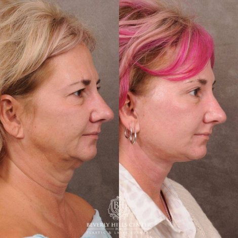 Beverly Hills Center Female Patient Before and After Comprehensive AuraLyft