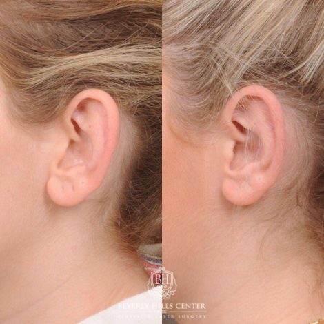 Beverly Hills Center Female Patient Before and After Otoplasty