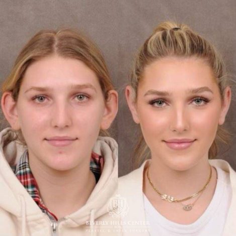 Beverly Hills Center Female Patient Before and After Otoplasty