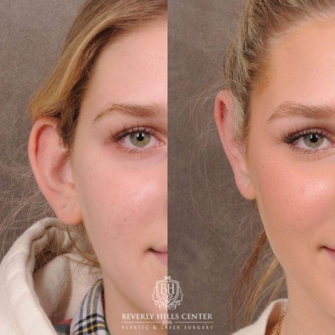 Beverly Hills Center Female Patient Before and After Otoplasty