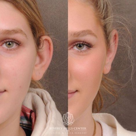 Beverly Hills Center Female Patient Before and After Otoplasty