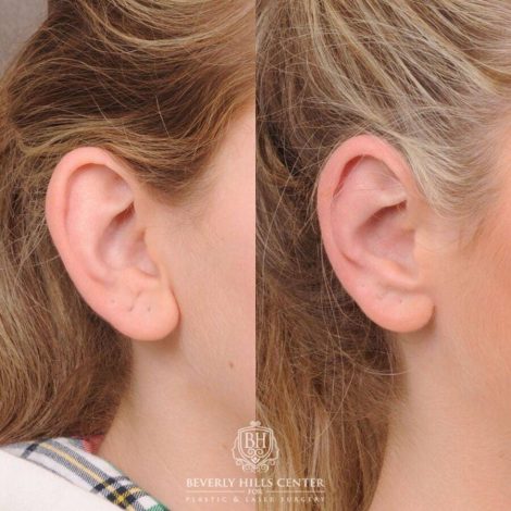 Beverly Hills Center Female Patient Before and After Otoplasty