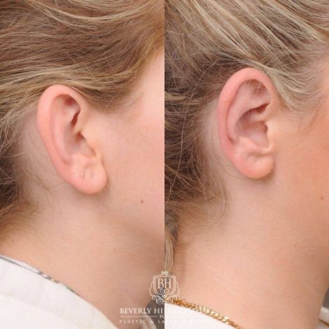 Beverly Hills Center Female Patient Before and After Otoplasty