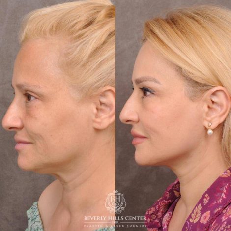 Beverly Hills Center Female Patient Before and After AuraLyft & Hybrid Brow Lift