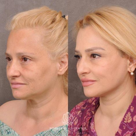 Beverly Hills Center Female Patient Before and After AuraLyft & Hybrid Brow Lift