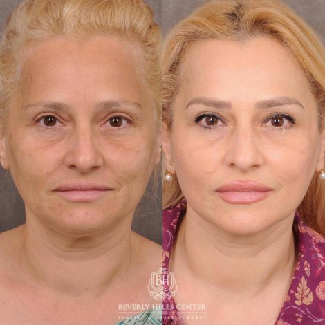 Beverly Hills Center Female Patient Before and After AuraLyft & Hybrid Brow Lift