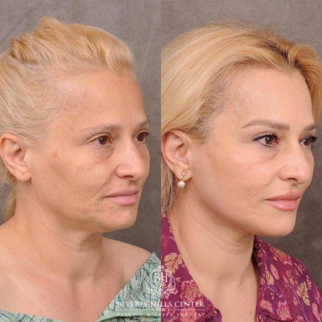 Beverly Hills Center Female Patient Before and After AuraLyft & Hybrid Brow Lift