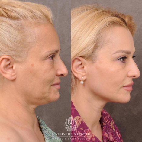 Beverly Hills Center Female Patient Before and After AuraLyft & Hybrid Brow Lift