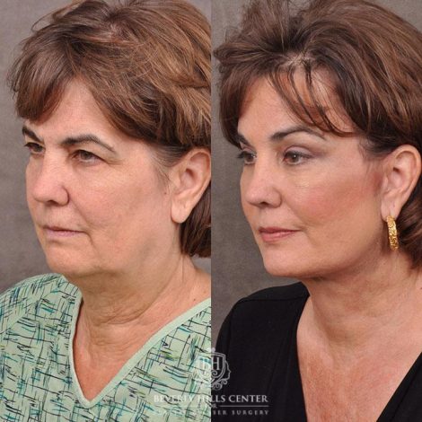 Beverly Hills Center Female Patient Before and After AuraLyft, Browlift & Blepharoplasty Procedures