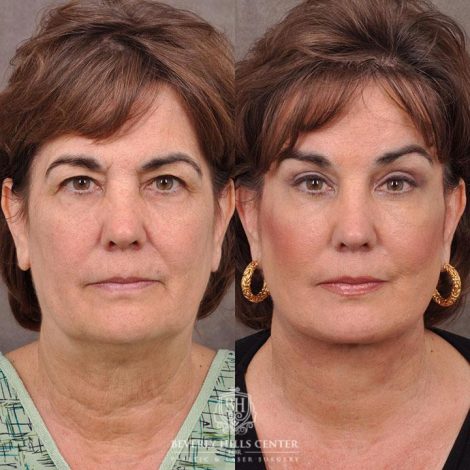 Beverly Hills Center Female Patient Before and After AuraLyft, Browlift & Blepharoplasty Procedures