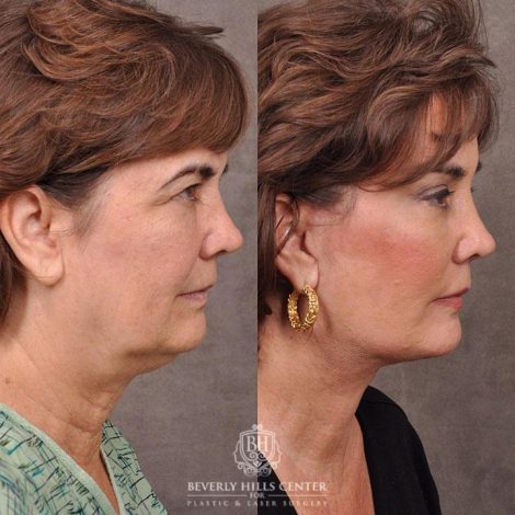 Beverly Hills Center Female Patient Before and After AuraLyft, Browlift & Blepharoplasty Procedures