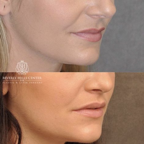 Beverly Hills Center Female Patient Before and After Modified Upper Lip Lift