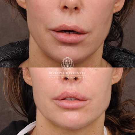 Beverly Hills Center Female Patient Before and After Deep Plane Modified Upper Lip Lift Procedure