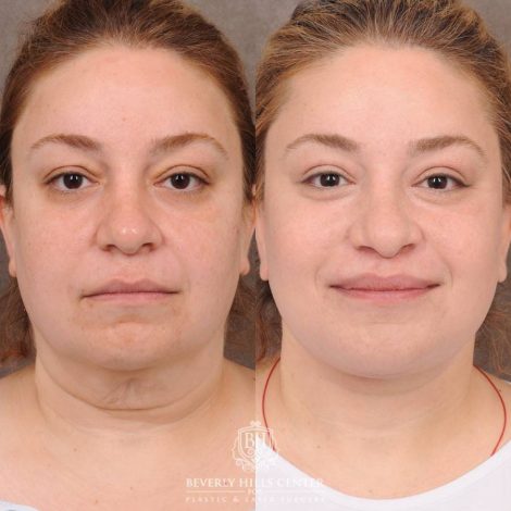 Beverly Hills Center Female Patient Before and After Auralyft, CUPID LIFT® Lip Lift, Upper Blepharoplasty