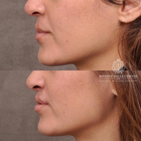 Beverly Hills Center Female Patient Before and After CUPID LIFT® Corner Lift Procedure