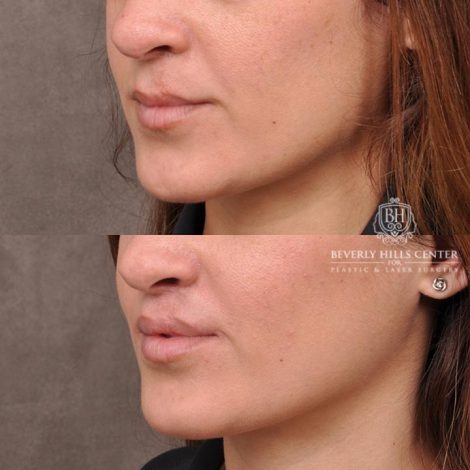 Beverly Hills Center Female Patient Before and After CUPID LIFT® Corner Lift Procedure