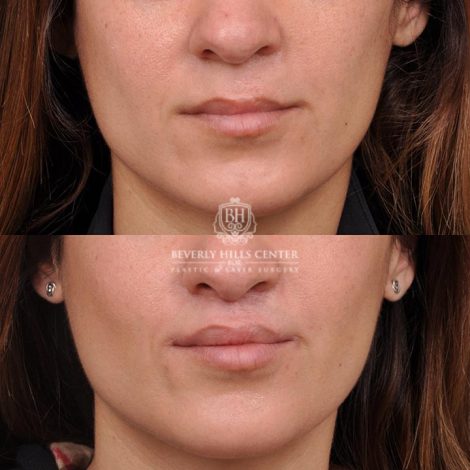 Beverly Hills Center Female Patient Before and After CUPID LIFT® Corner Lift Procedure