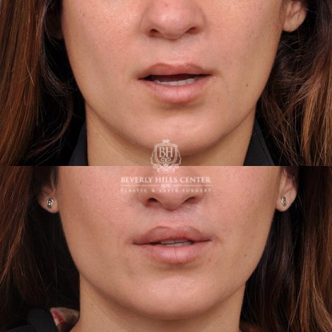 Beverly Hills Center Female Patient Before and After CUPID LIFT® Corner Lift Procedure