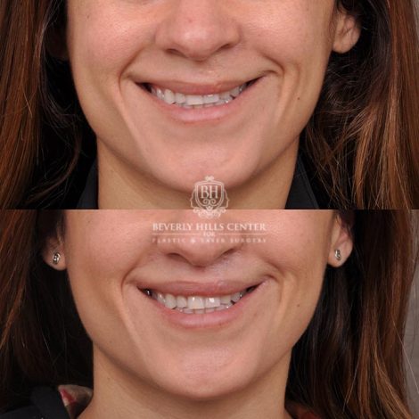 Beverly Hills Center Female Patient Before and After CUPID LIFT® Corner Lift Procedure