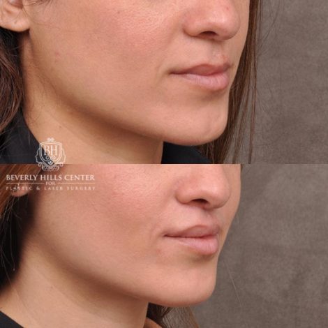 Beverly Hills Center Female Patient Before and After CUPID LIFT® Corner Lift Procedure