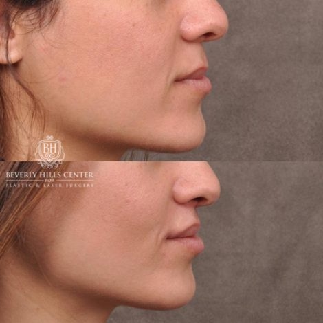 Beverly Hills Center Female Patient Before and After CUPID LIFT® Corner Lift Procedure