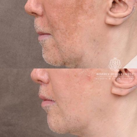Beverly Hills Center Male Patient Before and After CUPID LIFT® Corner Lift Procedure