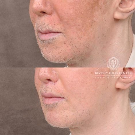 Beverly Hills Center Male Patient Before and After CUPID LIFT® Corner Lift Procedure