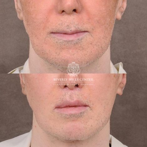 Beverly Hills Center Male Patient Before and After CUPID LIFT® Corner Lift Procedure