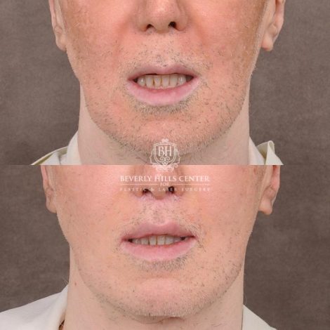 Beverly Hills Center Male Patient Before and After CUPID LIFT® Corner Lift Procedure