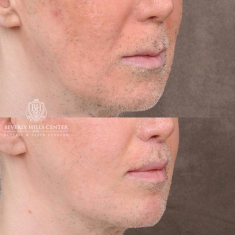 Beverly Hills Center Male Patient Before and After CUPID LIFT® Corner Lift Procedure