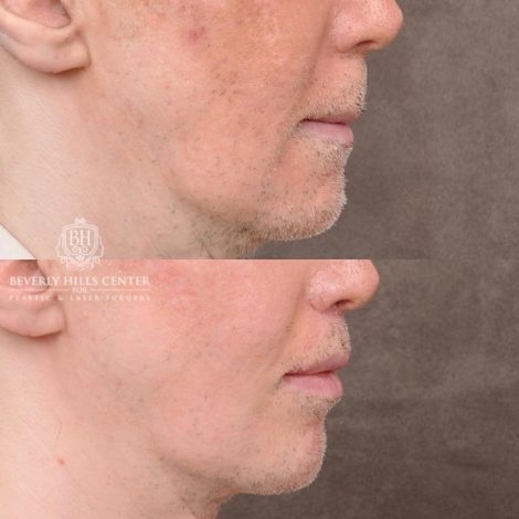 Beverly Hills Center Male Patient Before and After CUPID LIFT® Corner Lift Procedure