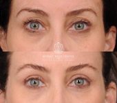 Beverly Hills Center Female Patient Before and After Upper Blepharoplasty with Fat Repositioning