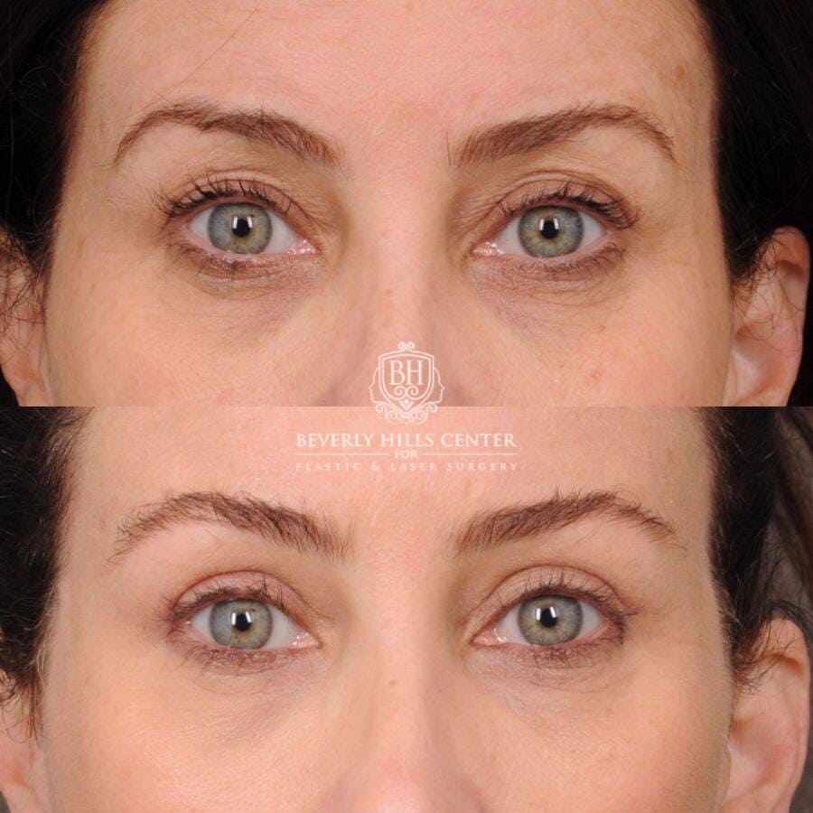 Beverly Hills Center Female Patient Before and After Upper Blepharoplasty with Fat Repositioning